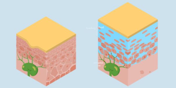 Der Unterschied zwischen Lipödem und Lymphödem